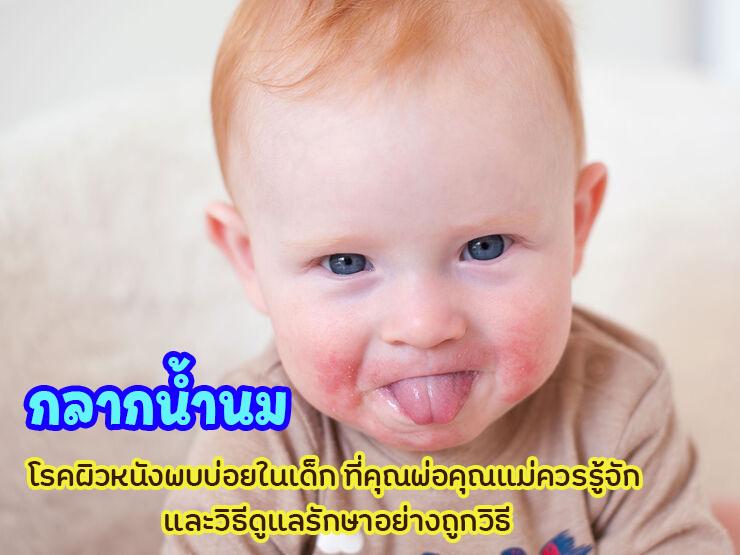 กลากน้ำนม